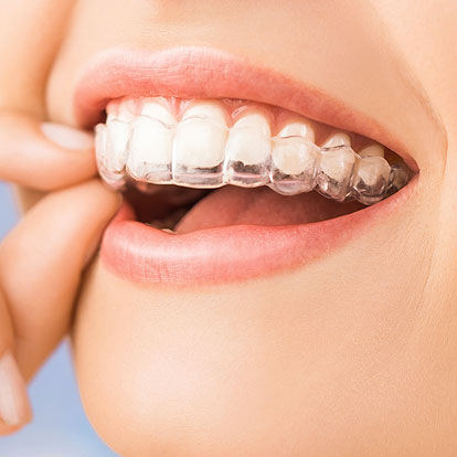Gouttières Invisalign, Smilers : l'orthodontie invisible