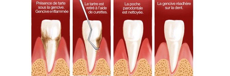 Surfaçage radiculaire chirurgien Dentiste Asnières sur Seine