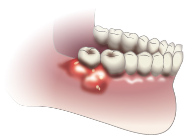 Abcès parodontale