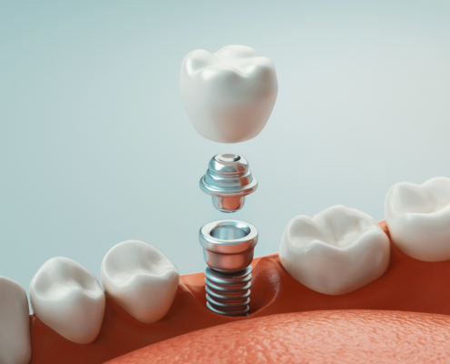 Implant dentaire Asnières sur Seine - Cabinet dentaire Dr Monsenego